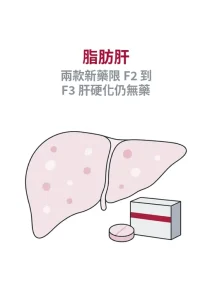 脂肪肝新藥適用於未肝硬化且纖維化 F2 至 F3 的治療分期圖