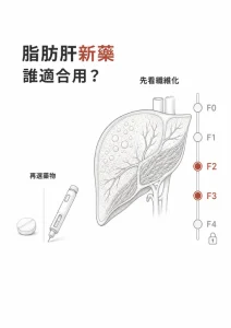 脂肪肝新藥適用於未肝硬化且纖維化 F2 至 F3 的治療分期圖