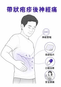 帶狀疱疹後神經痛的神經警報、局部貼片、口服治療與安全調藥示意圖