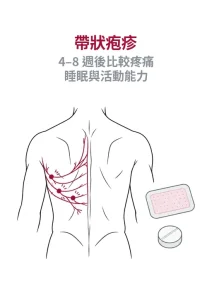 帶狀疱疹後神經痛的神經疼痛、局部貼片、口服治療、腎功能與四到八週評估示意圖