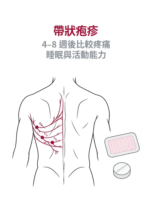帶狀疱疹後神經痛的神經疼痛、局部貼片、口服治療、腎功能與四到八週評估示意圖