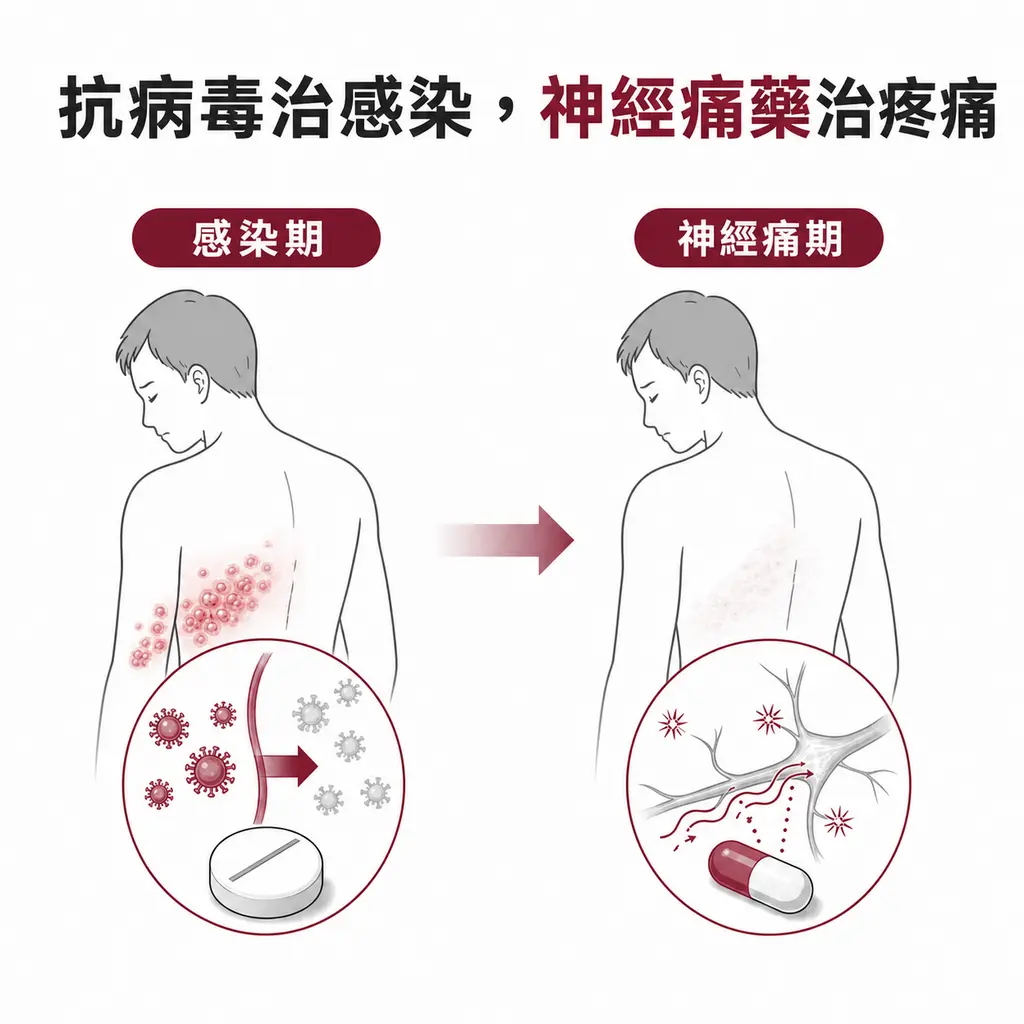 抗病毒藥處理帶狀疱疹感染期而神經痛藥處理持續疼痛訊號的對照圖
