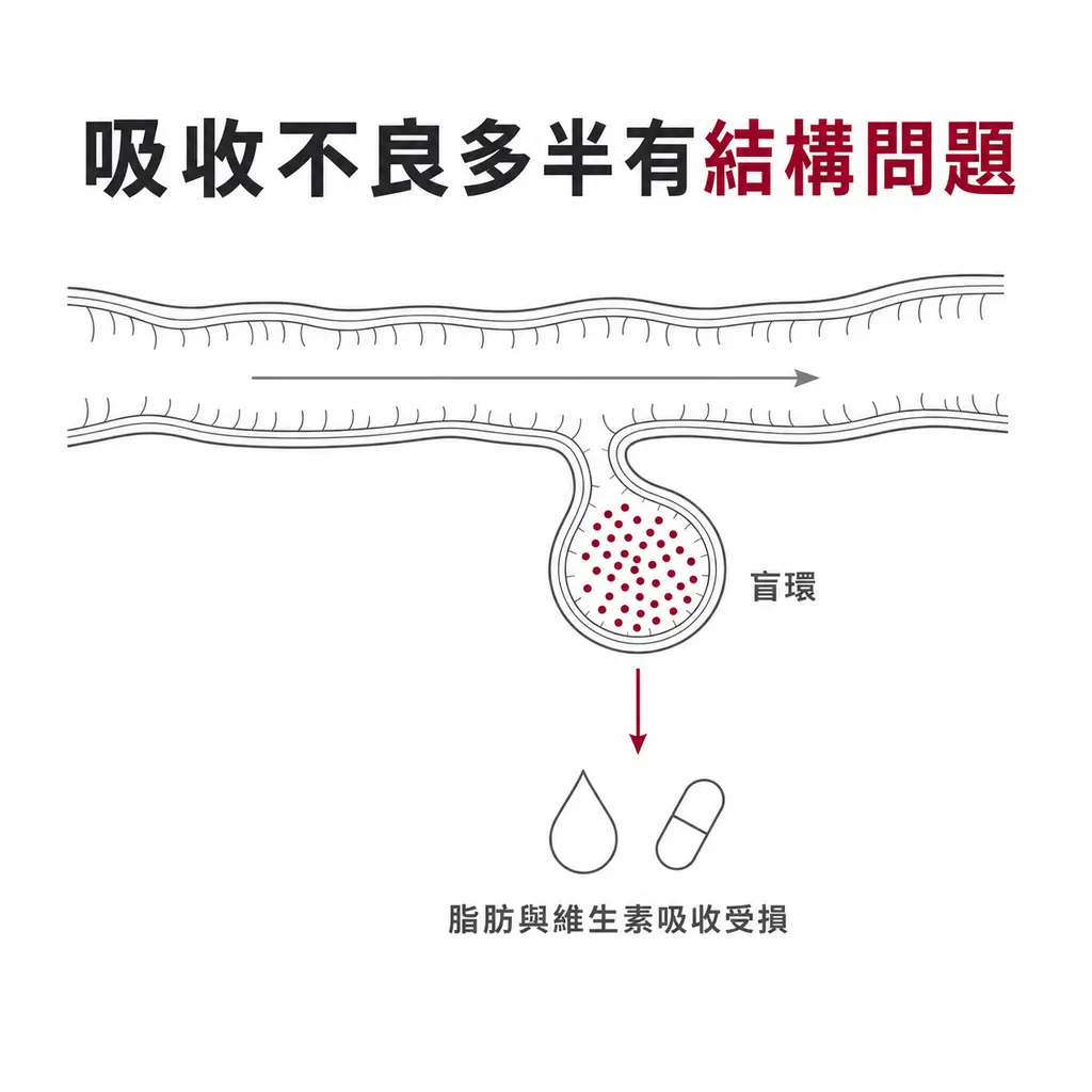 示意圖：小腸側邊的盲環形成死角，細菌困在其中大量增生，進而造成脂肪與維生素吸收受損