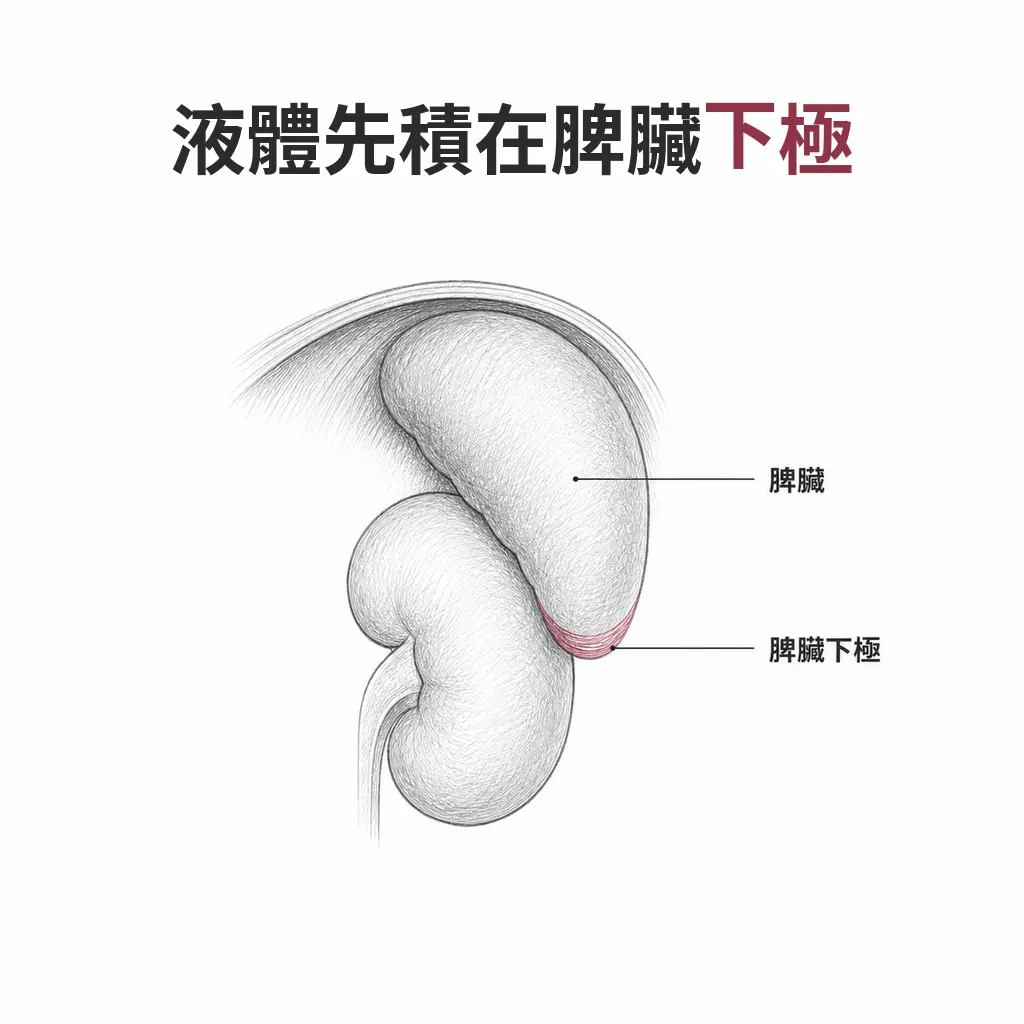 脾腎切面同時顯示橫膈、脾臟與左腎,游離液體先積在脾臟下極而不是脾腎之間