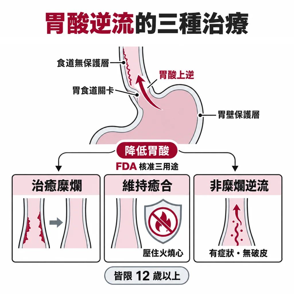 胃酸越過胃食道關卡燒傷食道,分為糜爛性與非糜爛性兩型;FDA 核准治療、維持癒合、非糜爛逆流三用途,限 12 歲以上