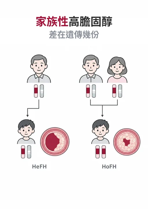 家族性高膽固醇血症分兩型：HeFH 與 HoFH 差在遺傳份數，壞膽固醇可差到 10 倍
